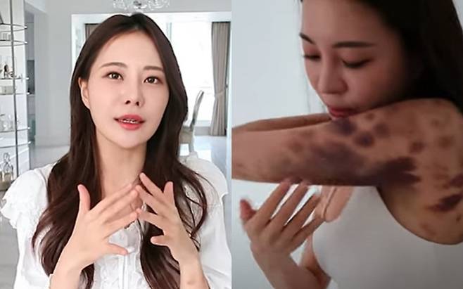 건강 주사를 맞은 뒤 전신에 피멍이 든 아옳이. 사진| 아옳이 SNS