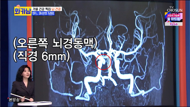 This level silver silver silver is heartfelt about virtual marriage.On TV CHOSUN family entertainment The Man Who Writes Wife Card (hereinafter referred to as Wakanam) broadcast on 19th, I recognized all of Yeo Esther and Brain Disease.Silver silver and This level started with one blanket covered and surprised everyone - the two also brushed their teeth together.The silver silver said, Do you want to wipe each other?Then a call came to the writer of Cobik: Asked if he could appear with Silver Silver, Silver Silver beamed, saying, I want to try.The ponderers headed together to the cobik waiting room; This level said, Im sorry.I did it, and my colleagues constantly teased, Why are you taking such a hard way? My brother has no gap. SilverSilver silver surprised everyone by giving a huge amount of acting power, vocalization, and kissing this level ball in this recording.This level was also surprised and did not say anything and continued to say, Do not come close.Silver silver wiped this level directly with a towel, creating a sweet atmosphere. This level said, Where you kissed, you will not wash for a while.Then youre not going to get my kiss now, just wash your face, Silver Silver said chicly.This level said, Why is there such a life on your feet?This level, which has a nationally certified nail art certificate, has been equipped with full-scale equipment, starting with foot baths that relieve foot fatigue with hot water.Thats when This Levels mother suddenly came in and surprised Silver Silver.So startled, Silver Silver accidentally hit This Level in the face and even spilled the footy water, making a mess: I think it fits me well.I would rather have a baby here. He said, I will look after the baby when I have a baby. This level said, Where do you want to live together? Dr. Yeo Esther, a preventive medicine doctor, said, With the theme of Brain Graduation, Yeo Esther said, It was the cause of death in the first place except cancer.I am more afraid of Brain Joljung than of heart disease. Heart disease does not go long term, but Brain Joljung can last decades.Hypertension, diabetes, cholesterol and smoking are the causes. If you do not always fit the buttons, do not have a car key, or have a pronunciation or open your eyes, you can not suddenly see it, explained Brain Chole as an early symptom.Choi Yong-soo, who also has diabetes, said, I smoke. Its been about five years. I did not smoke when I was a player.I do not have to worry about it now, but I would like you to do a detailed test with contrast agents, said Yeo Esther.Next is Silver Silver, Yeo Esther, who said, There is a possibility of microtumor in the Brain pituitary; only the name is so hump.I have already been diagnosed. Its been more than 10 years since the tumor was formed, five times bigger than others.But there is no big problem, so I can just live. Yeo Esther said, In that case, you can just think of it as a point on your face. Yeo Esther said, Jung Il-woo, Yoon Gye-sang, Ahn Jae-wook also suffered from Brain-related diseases. Brain aneurysms are really time bombs.When the blood vessels become weak and twist like Lee, you can feel a pain like a hammer. When the Brain aneurysm bursts, paralysis from bleeding can occur.In the past, it was very rare, but Korea and Japan have the most brain aneurysms in the world and women are particularly vulnerable. Yeo Esther said: Brain aneurysms are eventually bursting, and lifelong anterior, with size-shaped positioning important.If the location is good and it is less than 4mm, and the shape is good, it may not explode for a lifetime. I have no hypertension, no diabetes, I have not smoked alcohol or smoke in my life, so I thought I was confident, Yeo Esther said.A 6mm size Brain aneurysm was diagnosed four years ago and has been present. Yeo Esther said: In cases like me, there can be other problems with the procedure, with a 1% chance of death.The blood vessels burst, died during the procedure, or were similar in probability. Seven to nine millimeters is a time bomb, and I am a grenade with a safety pin.I am a Physician who can manage the safety pins well so that they are not pulled. Yeo Esther revealed how to manage Brain aneurysms on her own: Steady weight and hdl high, while recommending Chungkukjang and Natto.Choi Yong-soo Jeon Yoon-jung called Hong Hyun-hee and silver silver silver.Choi Yong-soo said, When I saw wifes taste, it seemed good to share all of them with kimchi.Choi Yong-soo said coolly, Lee Ha-jeong doesnt even have any physical strength, so I didnt blow.Jeon Yoon-jung said, I really did a lot of tension about My mother-in-law and my first impression, and Choi Yong-soo said, I did everything I could say. Can I live with you?My mother-in-law agreed and said, I live together until my honeymoon. Silver silver said, I do not have charm, so it is hard to do that. Hong Hyun-hee said, I just had a hand-picked hand with my father-in-law.I like it when I get to it first, he showed a sample of his charming daughter-in-law.Silver silver asked, Can I expect to marry this level? I do not think I will eat noodles before that.