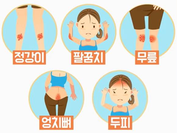 건선은 정강이, 팔꿈치, 무릎, 엉치뼈, 두피 등 자극을 받는 부위에 자주 발생한다. [사진=강동경희대병원]