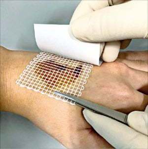 한 환자가 폐지방을 활용해 만든 창상피복제로 치료를 받고 있다. 창상피복제는 상처를 보호하고 체액 손실을 방지해주는 역할을 한다. / 사진=중소벤처기업부