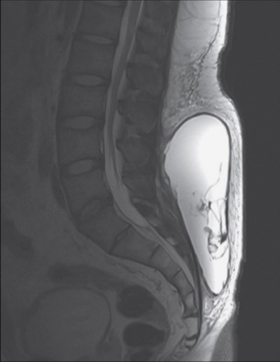 박형열, 김영훈 교수가 NEJM에 보고한 Morel-Lavallee 병변의 MRI 소견 이미지.