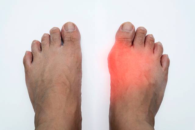통풍환자의 통증 해결에는 비스테로이드성 소염진통제가 효과적이다/게티이미지뱅크