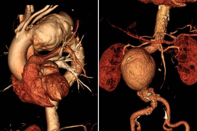 흉부대동맥(왼쪽)과 복부대동맥에 발생한 대동맥류 CT영상