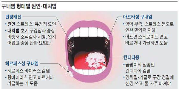 구내염에도 원인에 따라 아프타성 구내염, 헤르페스성 구내염, 편평태선, 칸디다증 등 다양하다./사진=헬스조선 DB