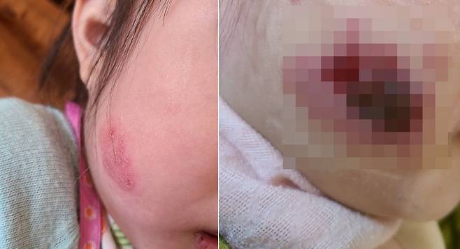 지난해 12월9일 5살 여아의 뺨에 수포가 난 모습(왼쪽)과 병원 치료 5일 후인 12월14일 뺨의 상태./온라인 커뮤니티