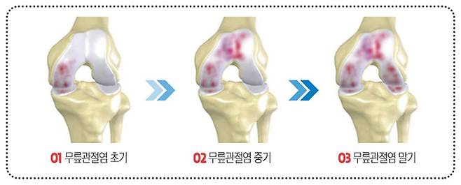 관절염 진행단계. 연세건우병원 제공.
