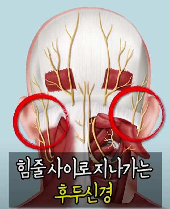 후두신경은 뒷머리 아래쪽에서 위로 올라오면서 승모근 힘줄 사이를 통과하는데, 승모근 힘줄 사이 통과 부위가 좁아 후두신경이 오래 눌려 있으면 후두신경통이 생길 수 있다./유튜브 신경외과 신사부 캡처