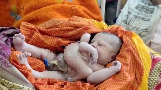 인도에서 팔과 다리가 4개인 아기가 태어났다. 인터넷 캡처