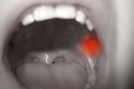 구내염은 유전적인 요인 외에 과로나 스트레스, 영양결핍 등으로 인한 면역 이상, 바이러스 침입, 나이에 따른 호르몬 변화 등으로 생기기도 한다. [사진 pixabay]