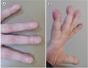 곤봉지 현상/사진=대한내과학회지