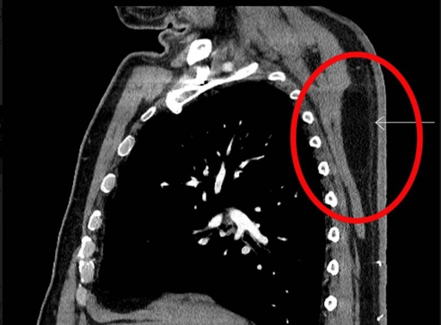 등에 지방종이 생긴 환자의 CT 영상. 순천향대 부천병원 제공