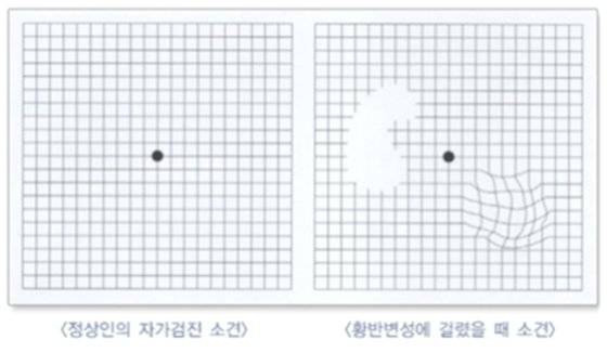 황반변성 증상. 사진 서울아산병원 제공
