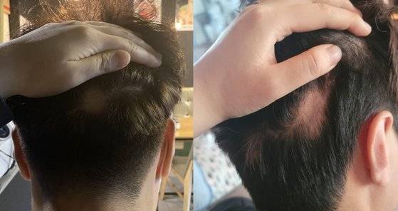 백신 접종 후 탈모 부작용을 호소한 A씨가 한 온라인 커뮤니티에 올린 사진. [사진=온라인 커뮤니티 캡처]