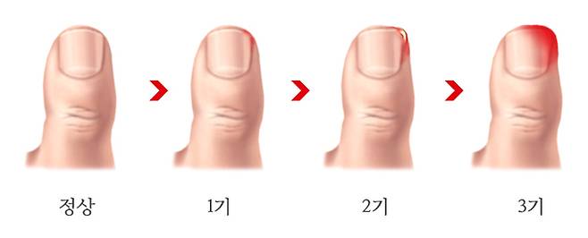 내성발톱 단계. 연세건우병원 제공.