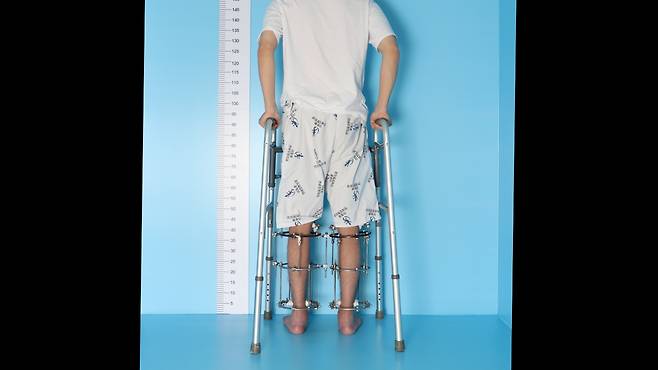 수술 후 외고정 장치를 착용한 환자의 모습. [이동훈연세정형외과 제공]