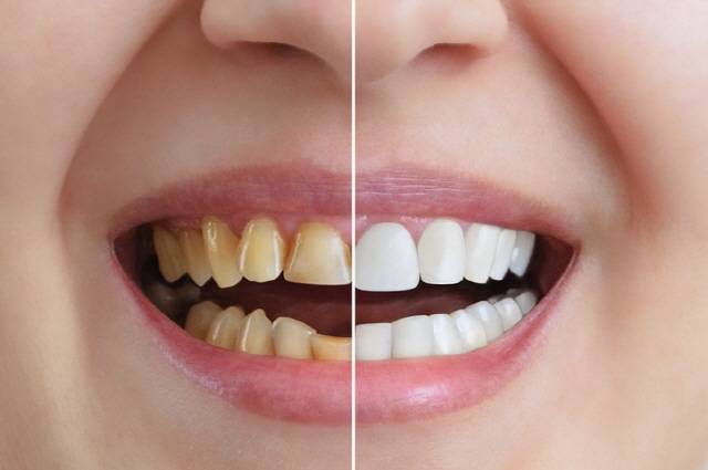 변색을 막으려면 색이 있는 식품을 먹었을 때 최대한 빨리 양치하고, 단단한 채소나 과일을 많이 먹는 것이 좋다./사진=게티이미지 뱅크