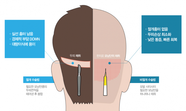 절개 모발이식과 비절개 수술법 비교 사진=모제림의원