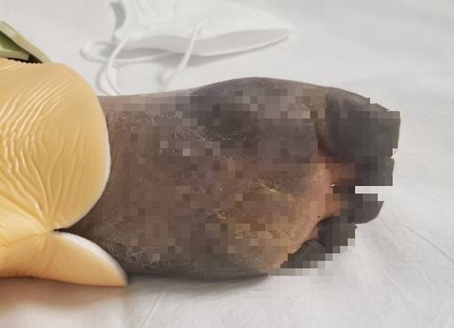 괴사된 A씨 여자친구의 왼쪽 발. 이후 상태가 악화돼 무릎 밑 7cm를 남기고 절단했다. [온라인 커뮤니티]