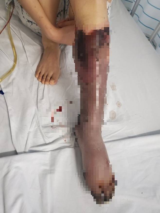괴사된 A씨 여자친구의 왼쪽 발과 다리. 현재는 무릎 밑 7cm를 남기고 절단했다. [온라인 커뮤니티]
