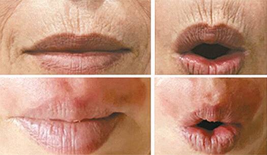 시술 후 한달, 붉은 피부색은 자외선 차단 등을 위해 선크림, 짙은 화장, 마스크 착용등이 필요하며 2~3개월 후 정상 피부색으로 돌아온다.