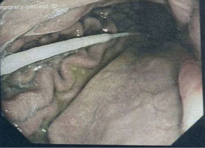 지난달 20일(현지시간) 코로나19 자가 진단 도중 목구멍에 면봉이 걸려 응급 술을 받은 영국인 바비 리의 면봉 제거 모습. 사운드 헬스 홈페이지 캡처. 뉴시스