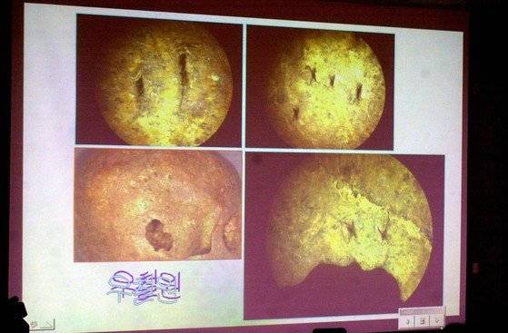 2002년 경북대의대에서 열린 법의학감정보고회에서 공개된 우철원군의 유골에 나있는 찍힌 흔적들．송곳등 쇠꼬챙이나 드라이버등으로 찍힌것으로 보인다는 법의학팀이 밝혔다. 중앙포토