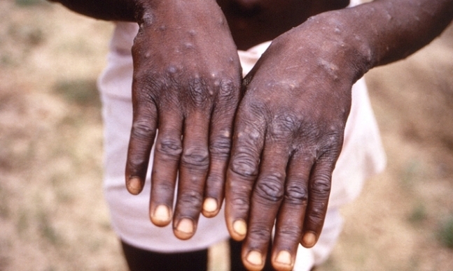 1997년 원숭이두창에 걸린 콩고민주공화국 환자가 미국 질병통제예방센터(CDC) 관계자에게 손등에 생긴 수포를 보이고 있다. CDC 제공