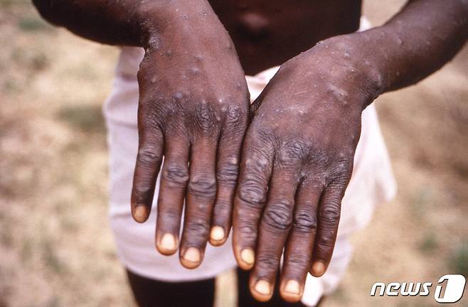 원숭이두창 감염자의 손 © AFP=뉴스1