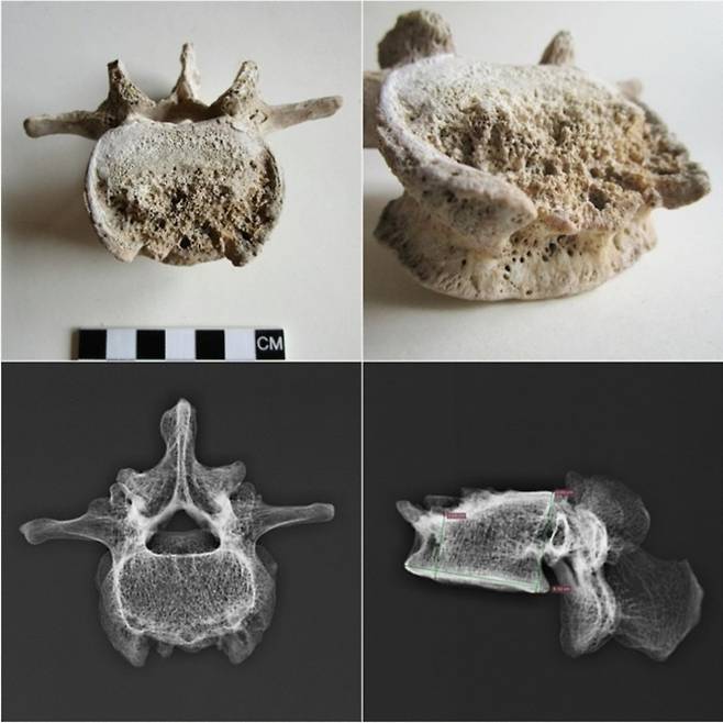 79년 고대 로마 시대 도시인 폼페이에서 화산폭발로 사망한 남성의 4번 요추(L4)의 모습이다. 결핵성 척추염 흔적이 발견됐으며, 관련 박테리아의 DNA도 검출돼 남성이 상망 전 결핵을 앓은 것으로 보인다. 사이언티픽리포트 제공