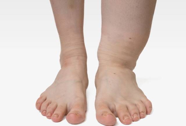 림프부종을 방치하다간 면역력이 떨어지고, 부은 그대로 조직이 딱딱해질 수도 있어 제때 치료받아야 한다. /사진=클립아트코리아