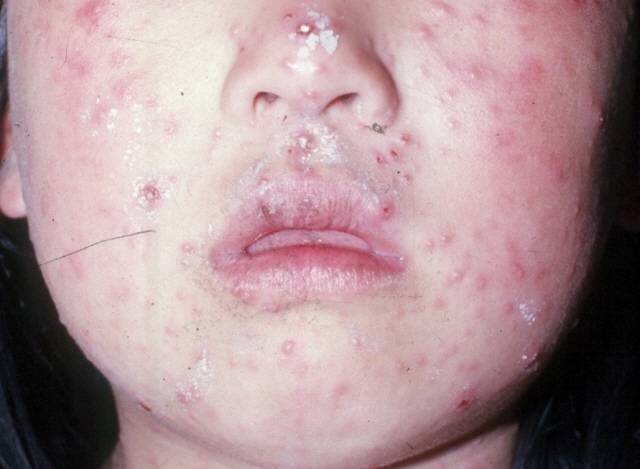 수두/의정부을지대병원 제공