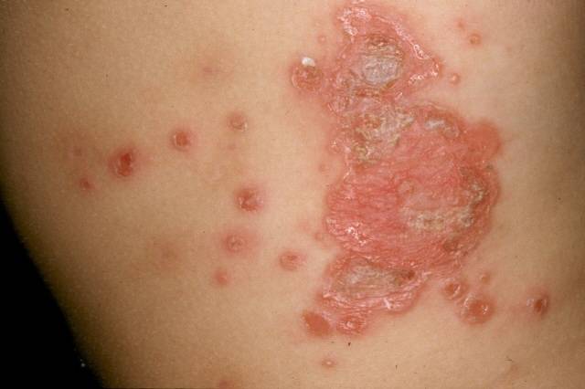 농가진/의정부을지대병원 제공