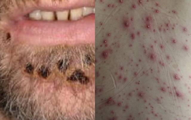 원숭이두창(왼쪽)과 수두에 의한 발진 증상. 원숭이두창은 동일 부위에 발진이 발생할 경우 병변 모양이 유사하지만, 수두는 다양한 양상을 보인다./한국과학기자협회, 서울대병원 제공