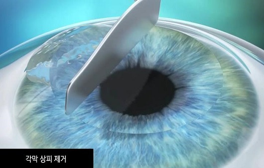 라섹 수술 과정ㅣ출처:비앤빛강남밝은세상안과