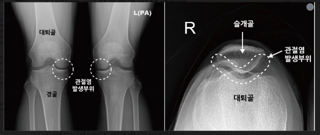 일반 무릎 관절염(왼쪽)과 슬개대퇴관절염의 연골 손상 부위. 바른세상병원 제공