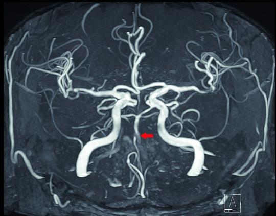 미니 뇌졸중을 경험한 환자의 뇌 MRI 영상. 붉은 화살표로 표시된 부위 뇌혈관이 막혀 끊긴 것처럼 보인다. 고려대 구로병원 제공