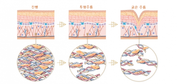 투명주름은 어떻게 생길까?