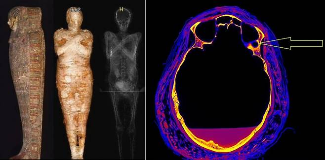 세계 최초이자 유일한 2000년 전 ‘임신한 미라’. 폴란드 바르샤바 미라 프로젝트 제공