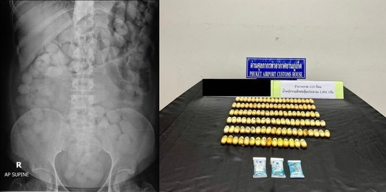 남아공 국적의 20대 마약 밀수범 몸 안을 찍은 엑스레이. 정체는 코카인이 든 비닐봉지 115개였다. [사진 태국 세관국 페이스북 캡처]