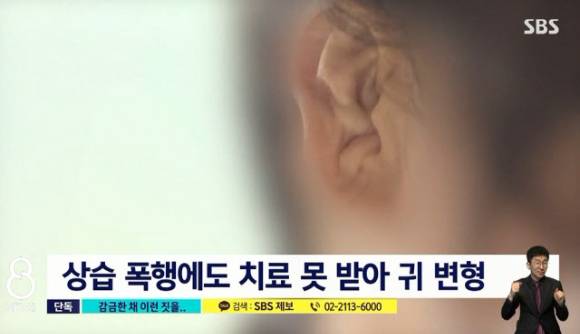 폭행당한 한 종업원의 양쪽 귀는 격투기 선수들이 지속적인 자극을 받아 생기는 질병인 이개혈종, 일명 '만두귀'가 되는 지경에 이르렀다. [사진=SBS '8시뉴스' 캡처]