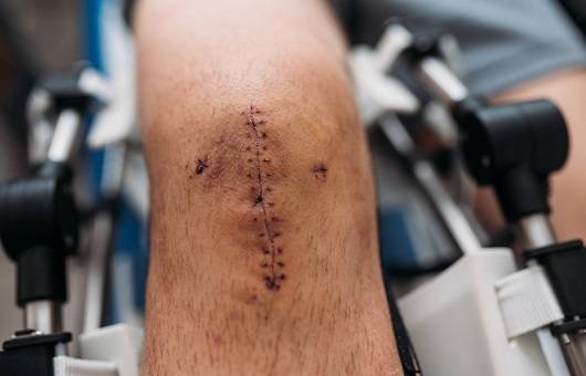 무릎 부위의 꿰맨 흉터｜출처: 게티이미지 뱅크