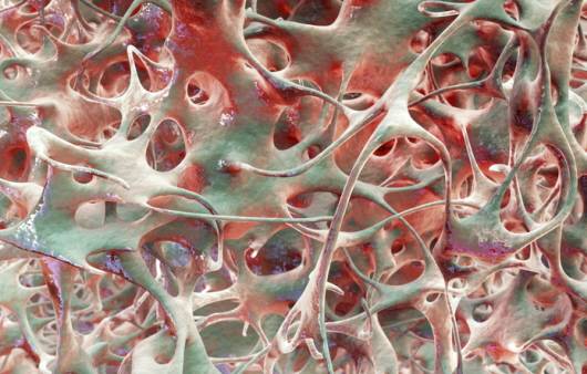 골다공증이 생긴 뼈의 모습ㅣ출처: 게티 이미지뱅크