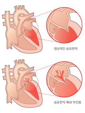 승모판막 역류증(승모판막 폐쇄 부전증)