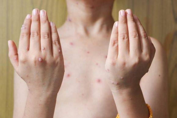세계보건기구(WHO)가 특정 집단이나 지역에 대한 차별과 낙인을 유발할 수는 원숭이두창(monkeypox) 명칭을 바꾸기로 했다. [사진=게티이미지]