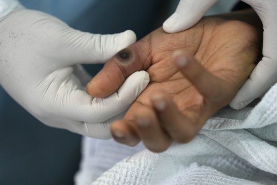 16일(현지시간) 페루 리마의 한 병원에서 의사가 원숭이 두창에 걸린 한 환자의 손가락을 보여주고 있다. 페루의 원숭이두창 신규 확진자는 15일 기준 122명으로 총 775명으로 집계됐다. /AP 뉴시스