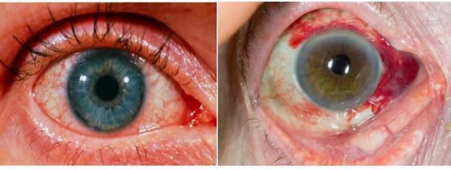 포도막염ㅣ출처: 비앤빛강남밝은세상안과