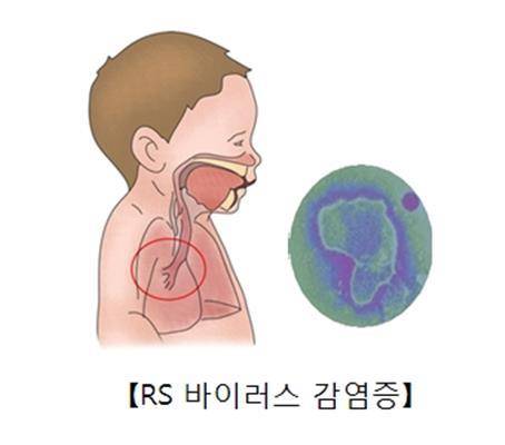 세포융합 바이러스(RSV) 감염증 [출처: 서울아산병원]