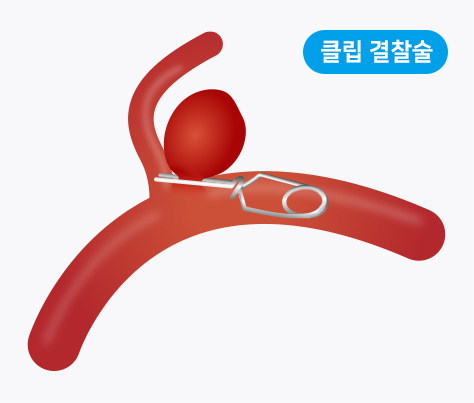 클립 결찰술. 사진제공|강동경희대병원