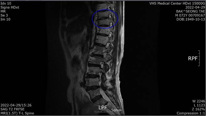 박성태 씨 4월 흉추 9, 10번 MRI 사진