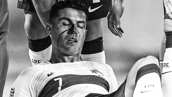 경기 중 체코 골키퍼와 충돌해 피투성이 된 포르투갈 호날두. 사진 더 선 캡처